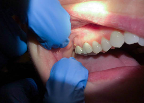 Best Emergency Tooth Extraction in Lake Cherokee, TX