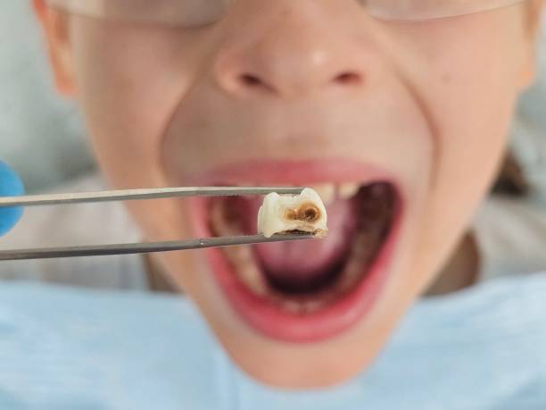 Best Emergency Treatment for Dental Infections or Abscesses in Lake Cherokee, TX